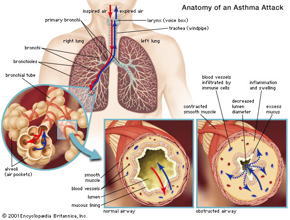 asthma2